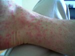 Petechial rash caused by Rocky Mountain Spotted Fever